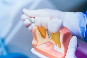 Implanty zębów Lublin